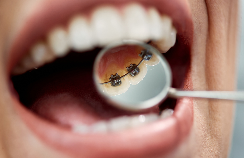 dientes con ortondoncia lingual en la clinica dental del doctor toledo en zaragoza