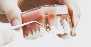 Endodoncia • Dental Company