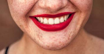 manchas-dentales