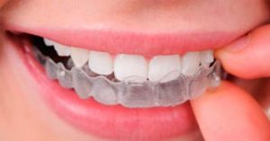 Bruxismo: ¿cómo afecta a los dientes y qué solución tiene?