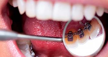 Ortodoncias transparentes: ¿cuál es la más estética y cuáles son las diferencias entre ellas?