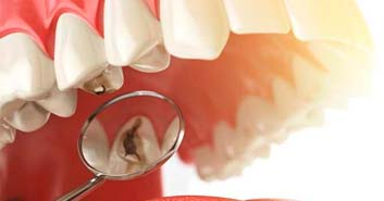 miniatura caries
