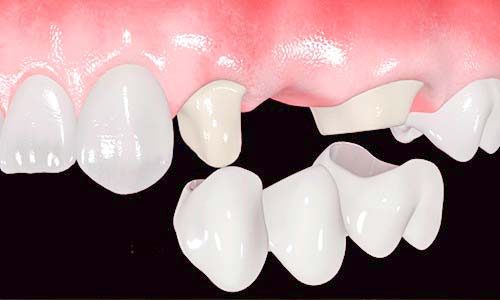 Cuál es la diferencia entre puente dental e implante