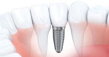 implantes dentales preguntas