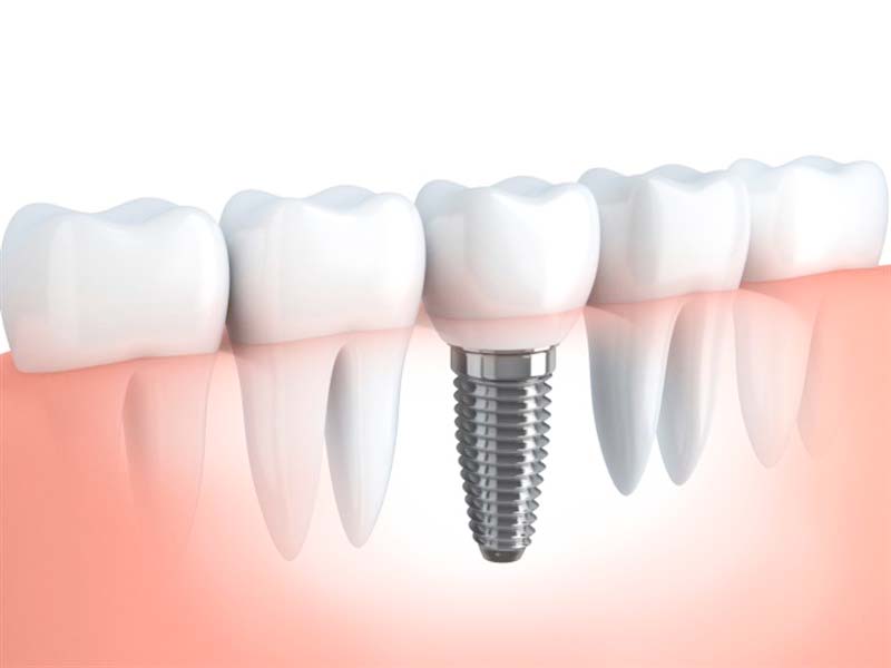 Preguntas frecuentes implantes dentales