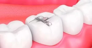 Empaste dental: tratamiento para eliminar la caries