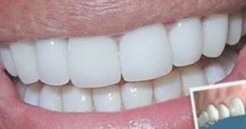 Empaste dental: tratamiento para eliminar la caries