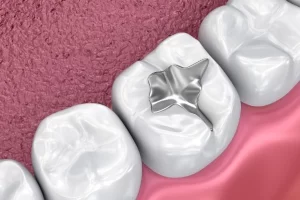 ¿Por qué es necesario cambiar los empastes dentales con el paso del tiempo?