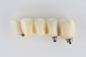 protesis dentales fijas