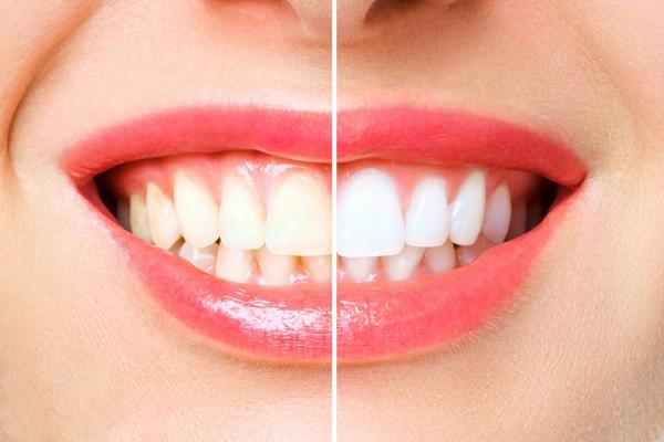 ventajas del blanqueamiento dental