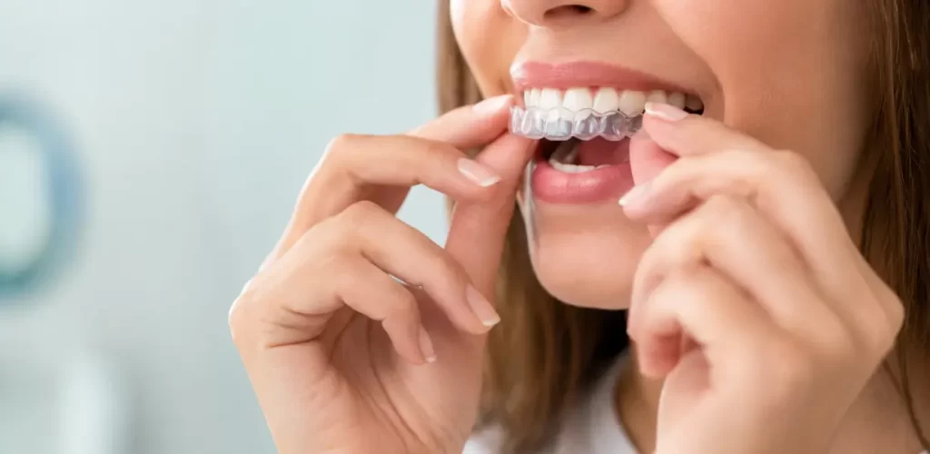 alineadores de invisalign