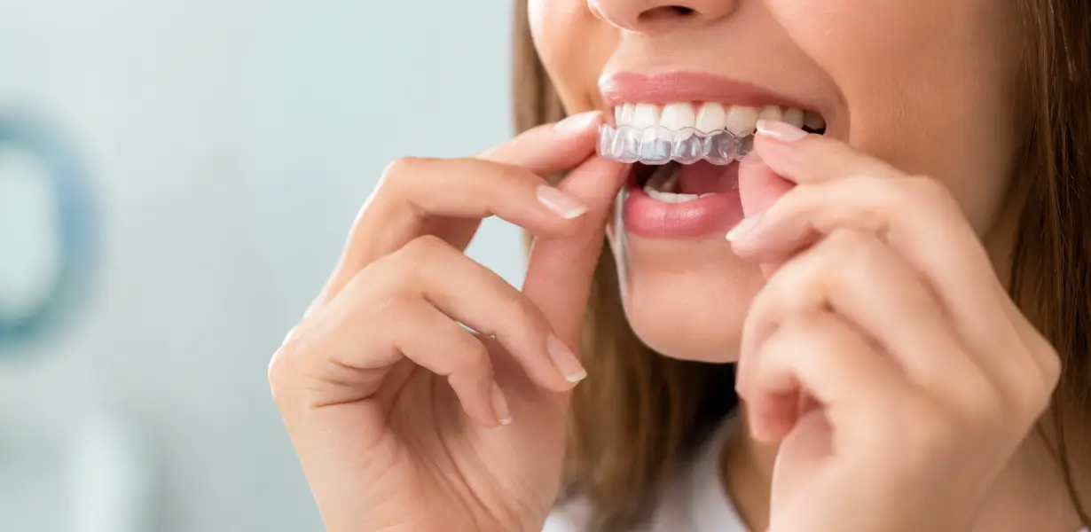 alineadores de invisalign