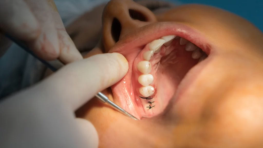 Medidas para después de una intervención de cirugía dental