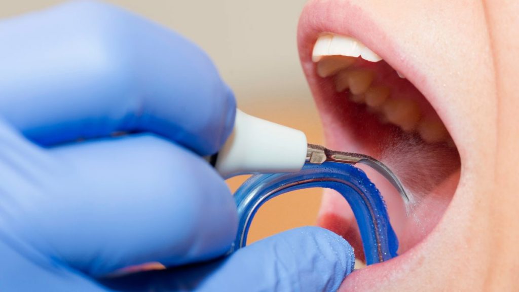 ¿Cada cuánto se debe hacer una limpieza dental?