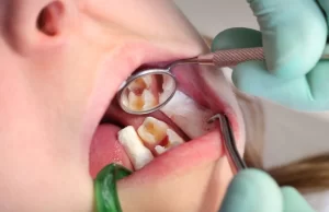 Primeros dientes de leche: cuidados y prevención de caries en los más pequeños