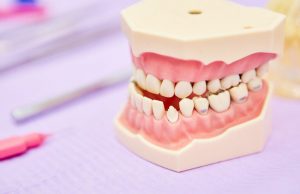 Maloclusión dental, causas, diagnostico y tratamiento