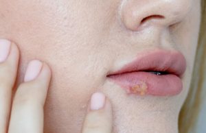 Herpes labial cómo evitarlo y tratarlo
