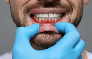 como saber si tengo gingivitis o periodontitis