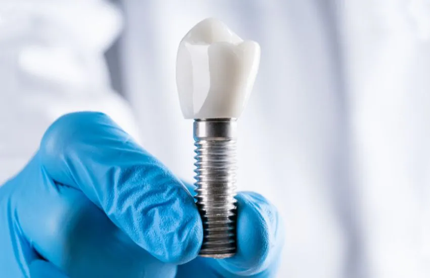 Cómo limpiar los implantes dentales