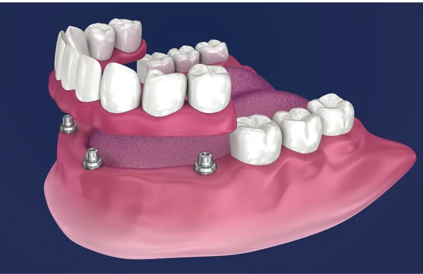 Sobredentaduras Una opción combinada de prótesis e implantes