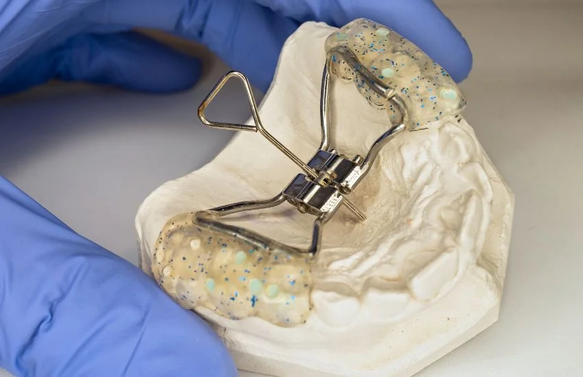 Aparato disyuntor de paladar sobre un modelo dental, sostenido por una mano con guante clínico